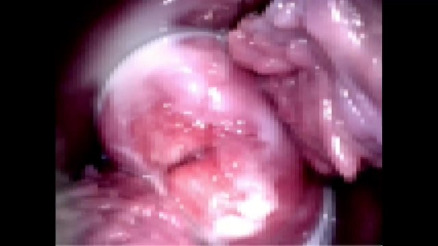 Cuzco's view of the cervix and vaginal wall