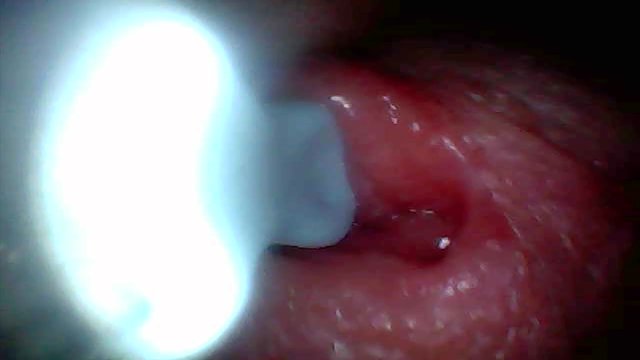 Endoscope camera captures moment of male ejaculation
