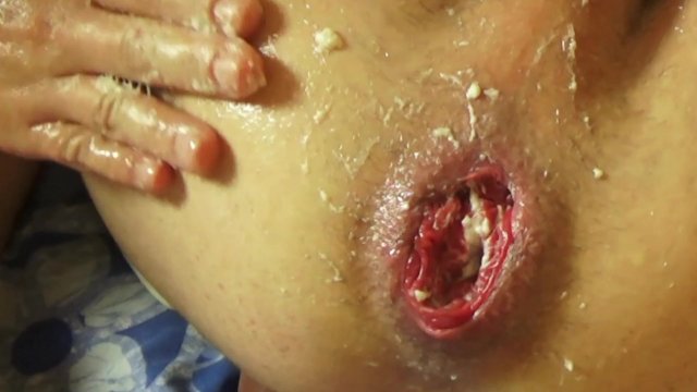 Penis pump prolapse gape ( Массаж простаты)
